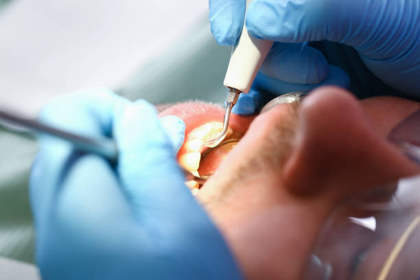 Best Emergency Tooth Extraction in Hephzibah, GA