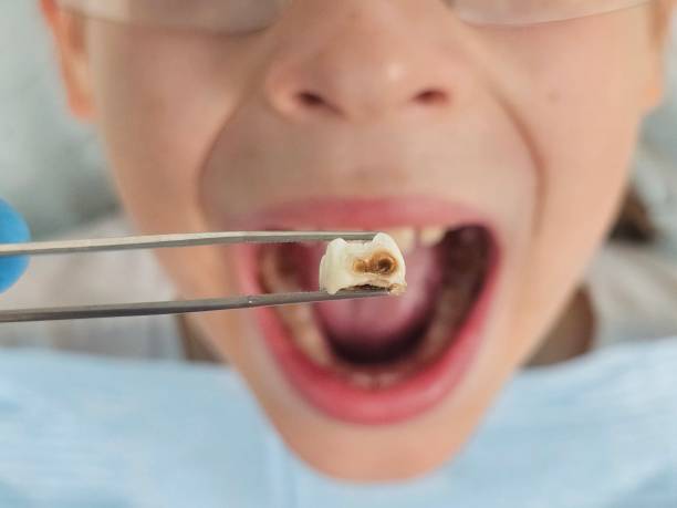 Best Emergency Treatment for Dental Infections or Abscesses in Hephzibah, GA
